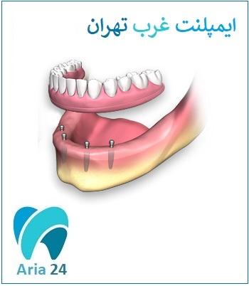 مرکز ایمپلنت دندان غرب تهران